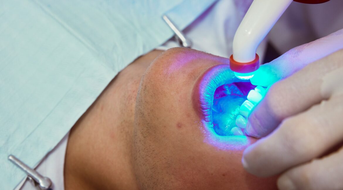 Teeth Whitening Methods