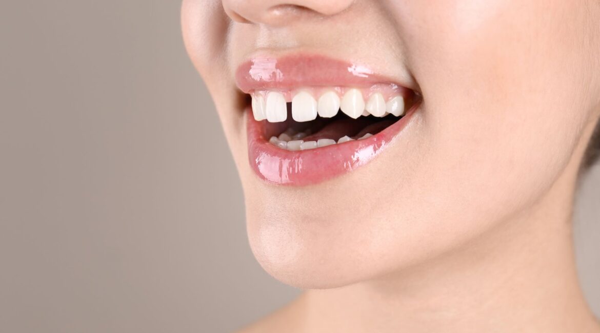 teeth gap