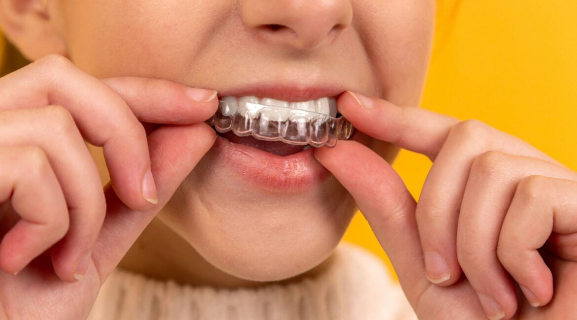 invisalign