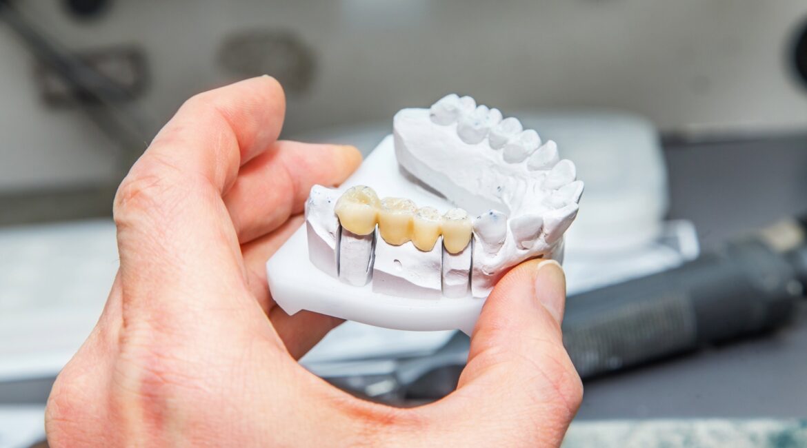 dental bridge