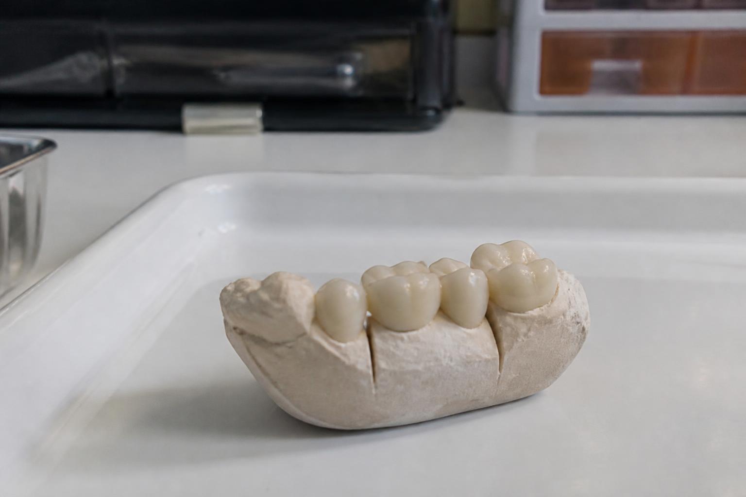 Fixed dental bridge restoration model on a dental tray